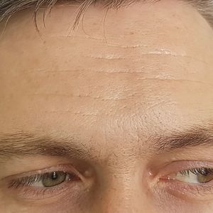 Wrinkles Start To Show after 40